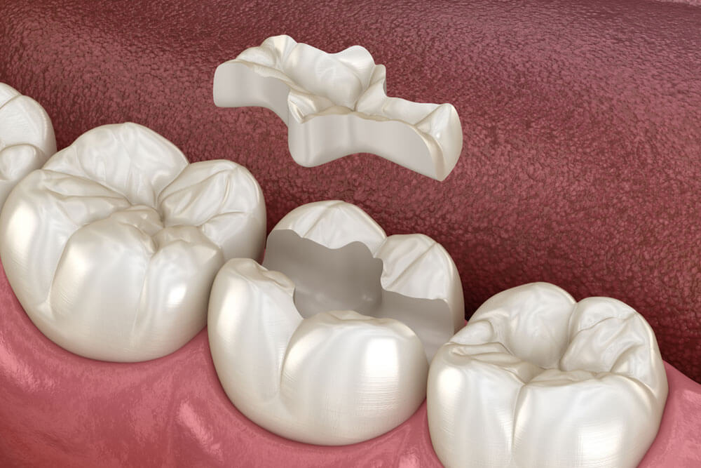 Medically accurate 3D illustration of human teeth treatment